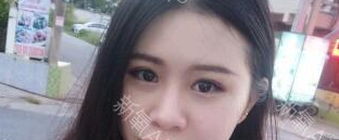 定點(diǎn)雙眼皮能保持多久？定點(diǎn)雙眼皮是永久的嗎？