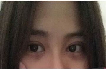 定點雙眼皮怎么做？定點雙眼皮需要拆線嗎？