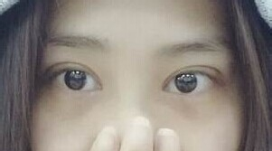 定點雙眼皮怎么做？定點雙眼皮需要拆線嗎？