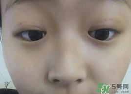 埋線雙眼皮需要拆線嗎？埋線雙眼皮怎么拆線