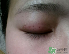 埋線雙眼皮需要拆線嗎？埋線雙眼皮怎么拆線