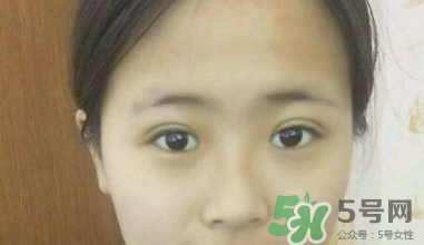 埋線雙眼皮需要拆線嗎？埋線雙眼皮怎么拆線