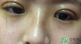 埋線雙眼皮需要拆線嗎？埋線雙眼皮怎么拆線