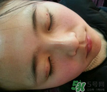 埋線雙眼皮需要拆線嗎？埋線雙眼皮怎么拆線