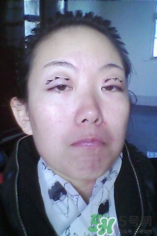 什么是定點雙眼皮？定點雙眼皮多少錢？