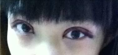 韓式三點(diǎn)雙眼皮是永久嗎？三點(diǎn)雙眼皮能保持多久？