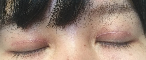 定點雙眼皮恢復過程圖_定點雙眼皮要多久恢復