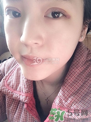 什么是定點雙眼皮？定點雙眼皮多少錢？