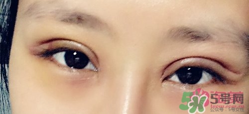 切開雙眼皮多久消腫？切開雙眼皮多久恢復(fù)？