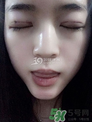 什么是定點雙眼皮？定點雙眼皮多少錢？