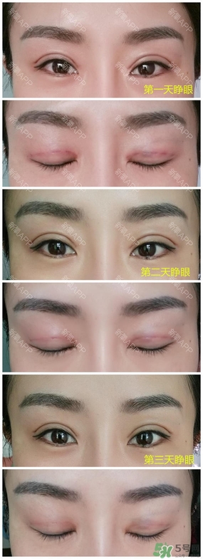 埋線雙眼皮能保持多久？埋線雙眼皮是永久嗎