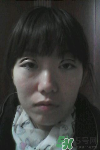 什么是定點雙眼皮？定點雙眼皮多少錢？