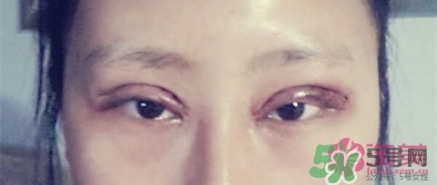切開雙眼皮多久消腫？切開雙眼皮多久恢復(fù)？