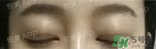 埋線雙眼皮多久恢復(fù)自然？埋線雙眼皮多久能恢復(fù)