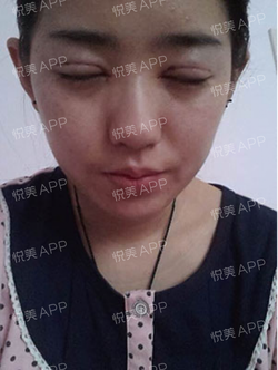 三點雙眼皮恢復過程圖_韓式三點雙眼皮多久恢復自然