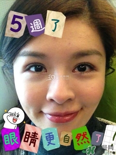重瞼術(shù)是什么？重瞼術(shù)是永久的嗎？