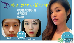 重瞼術(shù)是什么？重瞼術(shù)是永久的嗎？
