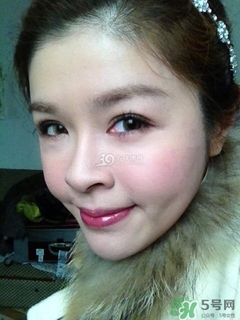 重瞼術(shù)是什么？重瞼術(shù)是永久的嗎？