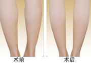 小腿吸脂多久見效？小腿吸脂后多久能看見效果？
