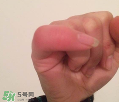 小拇指凍腫了怎么辦？為什么小拇指容易凍？