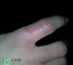 小拇指凍腫了怎么辦？為什么小拇指容易凍？
