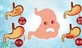 神經(jīng)性胃痙攣是什么？神經(jīng)性胃痙攣是什么原因？