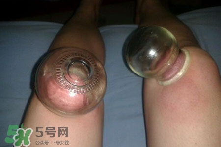 小腿能拔罐嗎？在小腿上拔火罐有什么作用？