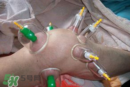 小腿能拔罐嗎？在小腿上拔火罐有什么作用？