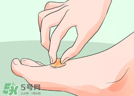 水泡怎么處理？水泡要不要刺破？