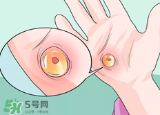 水泡怎么處理？水泡要不要刺破？