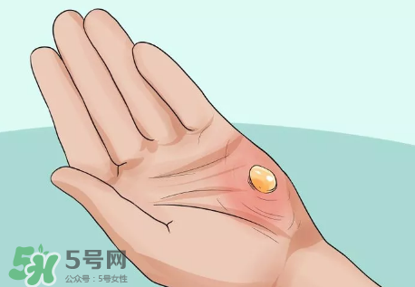 水泡怎么處理？水泡要不要刺破？