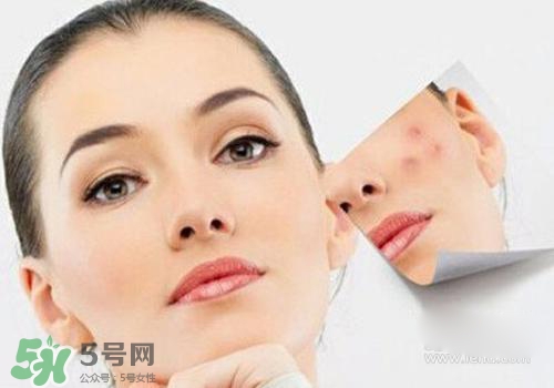 封閉性粉刺會自己消失嗎？封閉性粉刺好了會留疤嗎？
