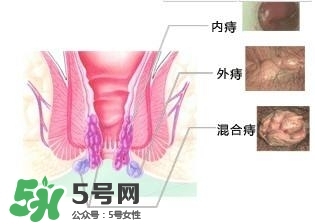 痔瘡吃什么藥效果好？痔瘡吃什么藥好得快？