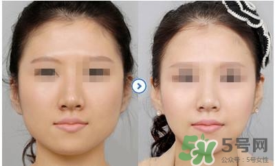 打瘦臉針疼不疼？打瘦臉針的注意事項(xiàng)