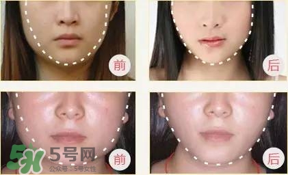 打完瘦臉針多久可以化妝？打完瘦臉針的反應(yīng)