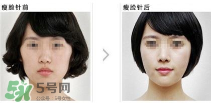 打瘦臉針能喝酒嗎？打瘦臉針能吃海鮮嗎？