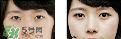 開(kāi)眼角要恢復(fù)多久？開(kāi)眼角好不好？