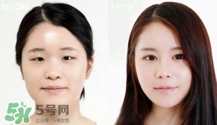 割雙眼皮有什么后遺癥嗎？割雙眼皮有什么危害性？
