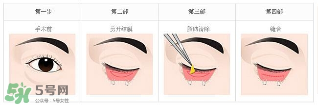 眼袋是怎么形成的？手術(shù)去眼袋安全嗎