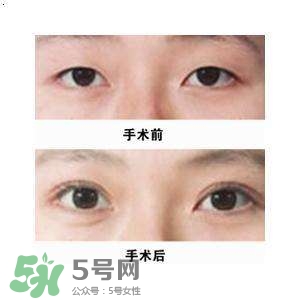 割雙眼皮疼不疼？割雙眼皮疼幾天能好？