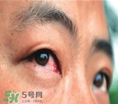 紅眼病是怎么引起的？紅眼病怎么產(chǎn)生的