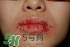 嘴唇干燥是什么原因？嘴唇干裂脫皮怎么辦？