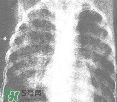 紅眼病是怎么引起的？紅眼病怎么產(chǎn)生的