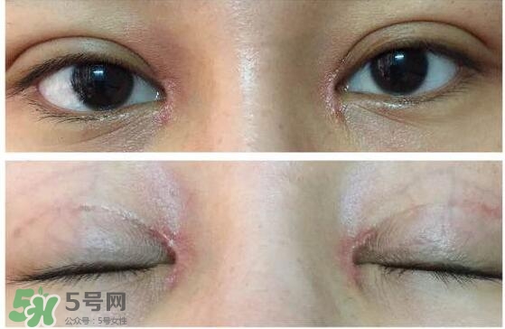 眼角增生是什么意思？眼角增生了怎么辦？