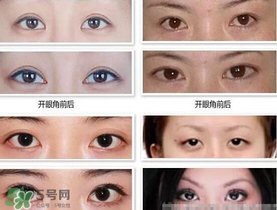 哪些人需要開眼角？需要開眼角的眼睛圖片