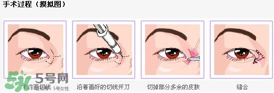 哪些人需要開眼角？需要開眼角的眼睛圖片