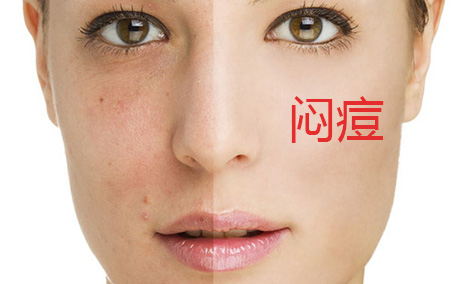 粉底液為什么會(huì)悶痘 粉底液悶痘的原因