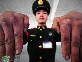 三月份還長凍瘡嗎？三月份凍瘡沒好怎么辦？