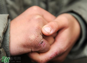 三月份還長凍瘡嗎？三月份凍瘡沒好怎么辦？