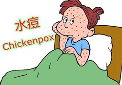 水痘是天花嗎？水痘是不是天花？